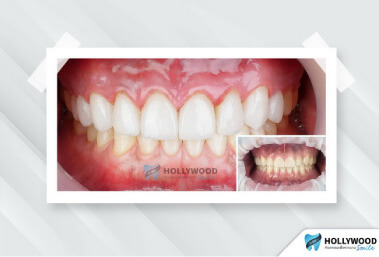 คลินิกทันตกรรม Hollywood Smile วีเนียร์ฟัน เคลือบฟันขาว แปะฟันขาว ฟอกสีฟัน ฟันปลอมถาวร
