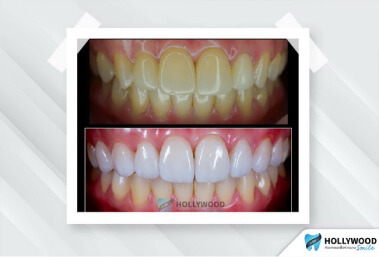 คลินิกทันตกรรม Hollywood Smile วีเนียร์ฟัน เคลือบฟันขาว แปะฟันขาว ฟอกสีฟัน ฟันปลอมถาวร