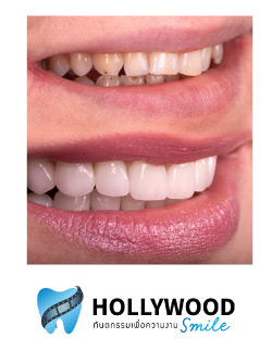 รีวิว วีเนียร์ฟัน เคลือบฟันขาว แปะฟันขาว ฟอกสีฟัน ฟันปลอมถาวร