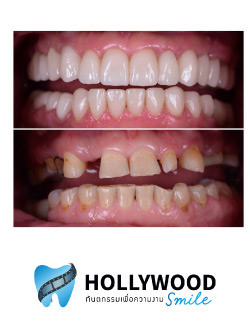 รีวิว วีเนียร์ฟัน เคลือบฟันขาว แปะฟันขาว ฟอกสีฟัน ฟันปลอมถาวร